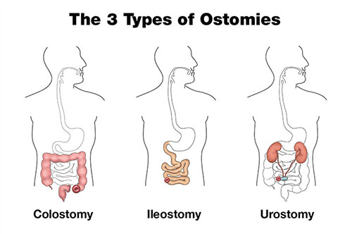 The 3 Types of Ostomies | Hollister US
