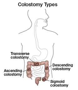 Ostomy Locations