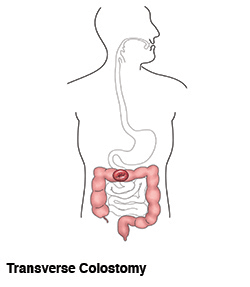 transverse-colostomy-ostomy-illustration