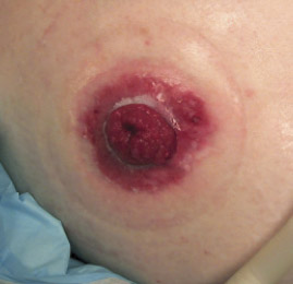 damaged-peristomal-skin