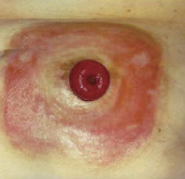 What You Need To Know About Skin Irritation Around Stoma Hollister Us