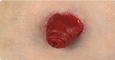 stoma-with-healthy-peristomal-skin-400x209